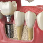 diş implantı