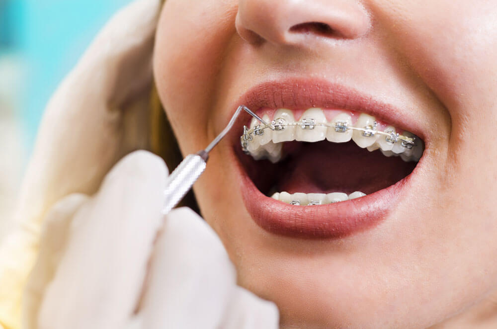 ortodonti nedir nasil tedavi edilir 20180226134509 1